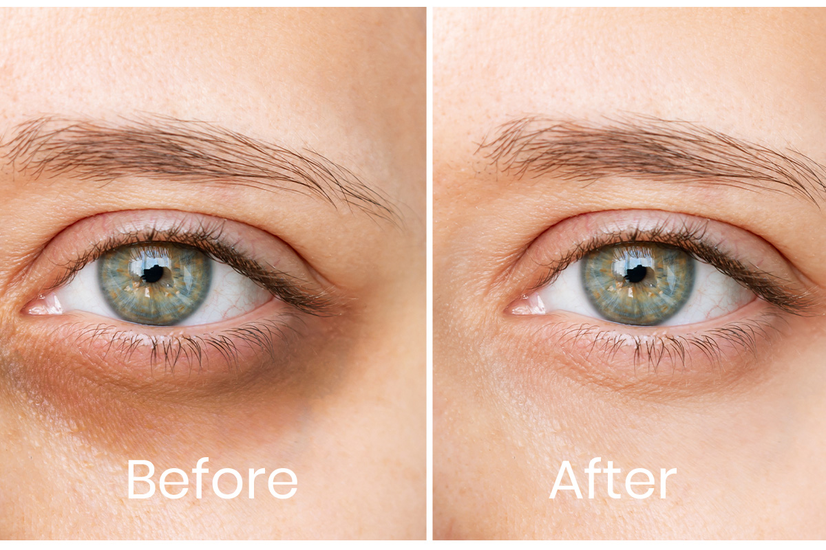 Dark Circles Treatment in Delhi