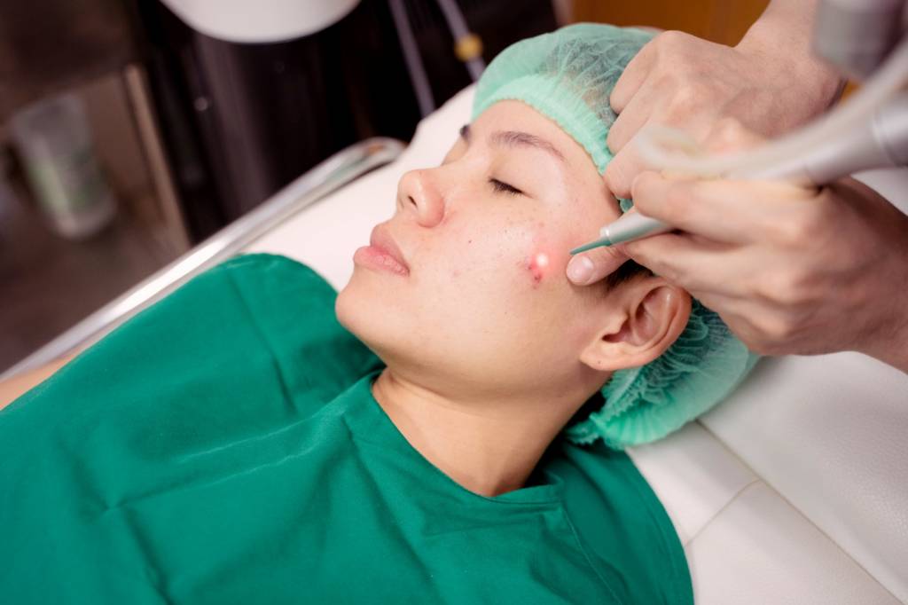 Dermatologist South Delhi for Acne Care