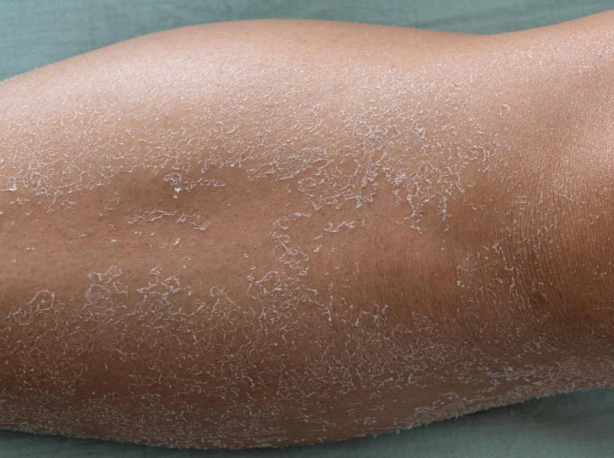 Dry Skin Treatment Options in Delhi