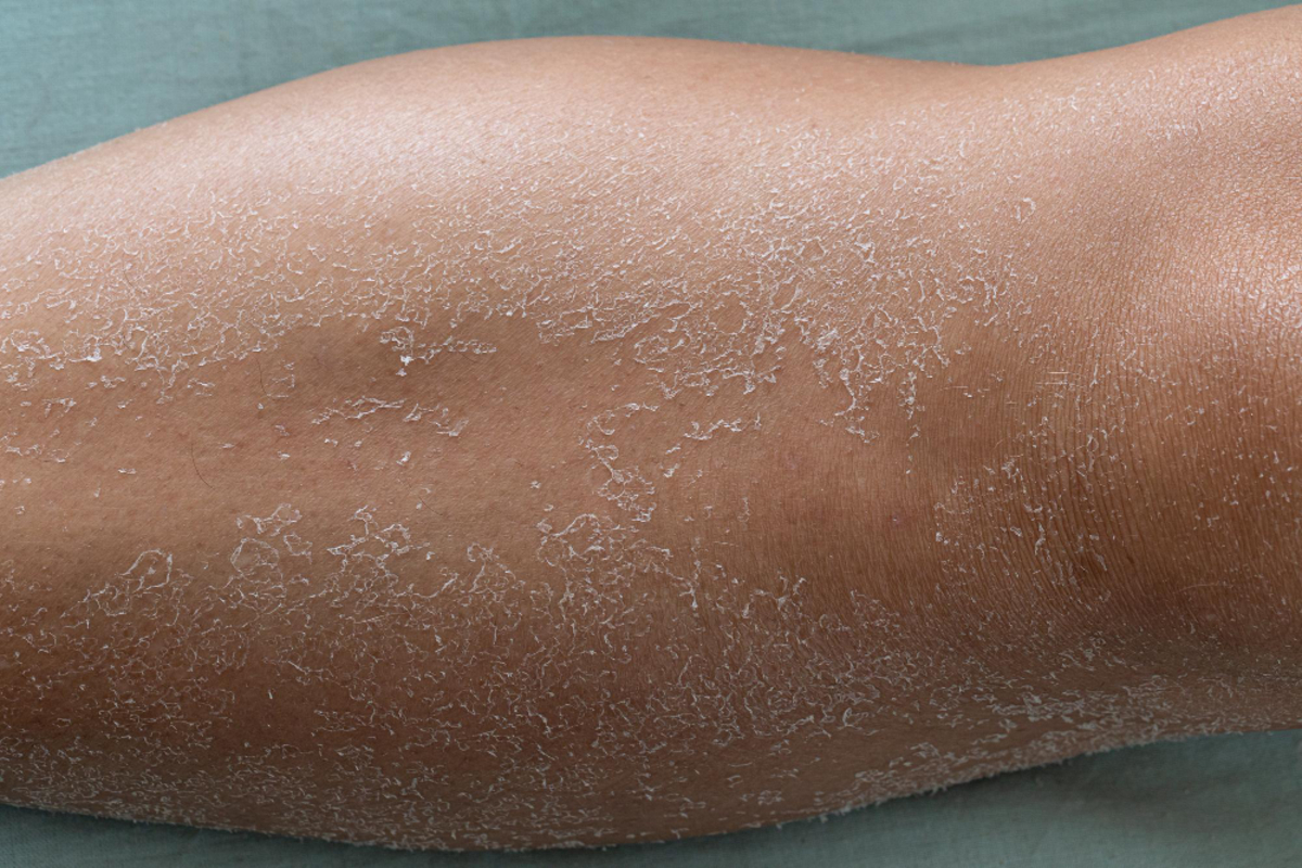 Advanced Dry Skin Treatment Options in Delhi