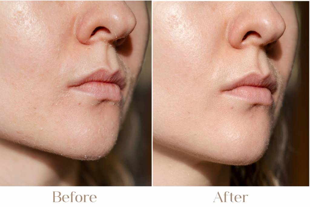 Advanced Dry Skin Treatment Options in Delhi