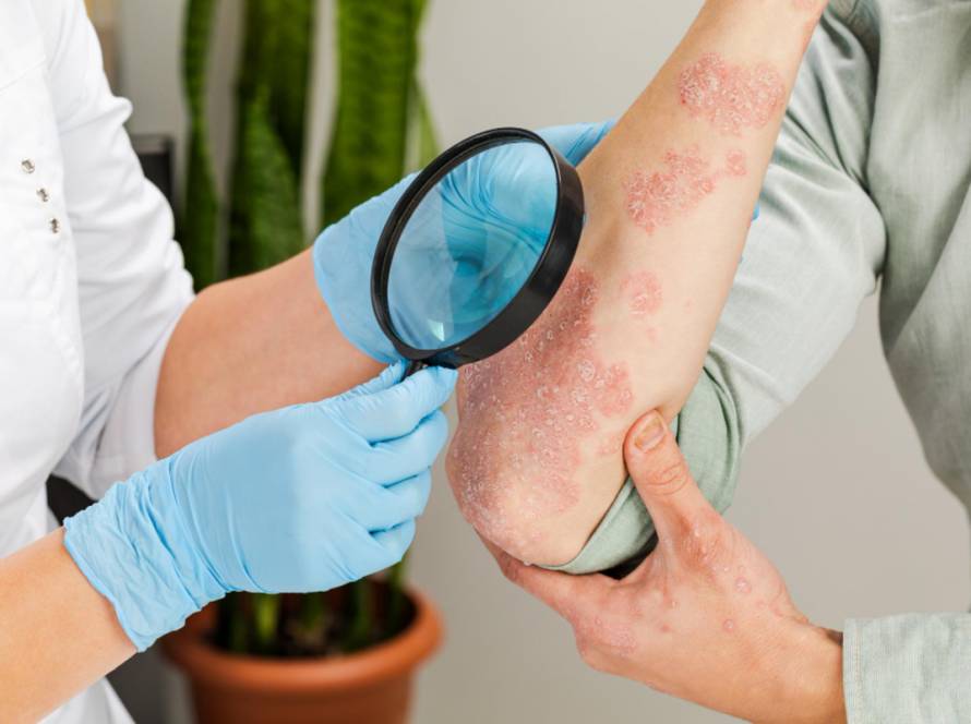 Eczema Treatment in Delhi