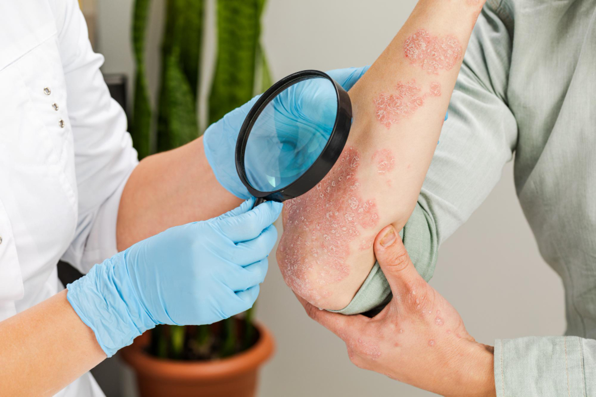 Eczema Treatment in Delhi