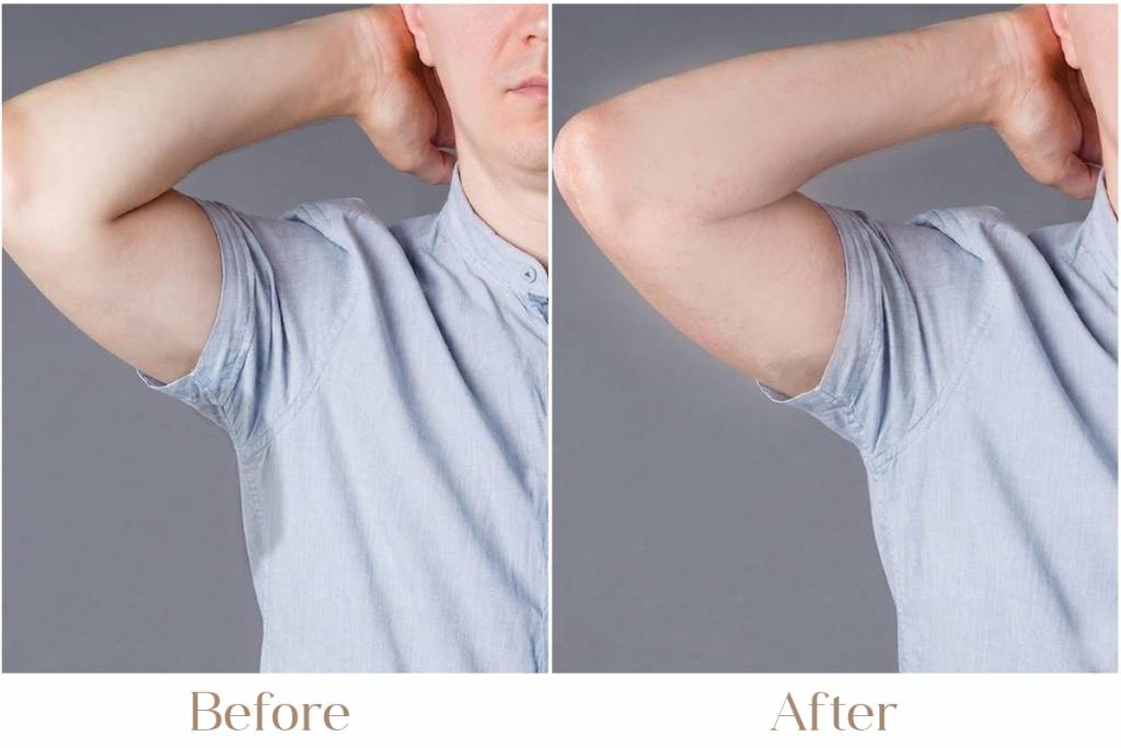 Hyperhidrosis – Excessive Sweating Treatment in Delhi