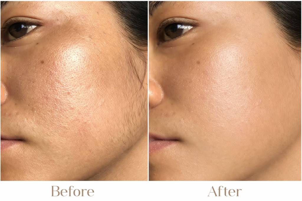 Laser Facial Hair Removal in Delhi