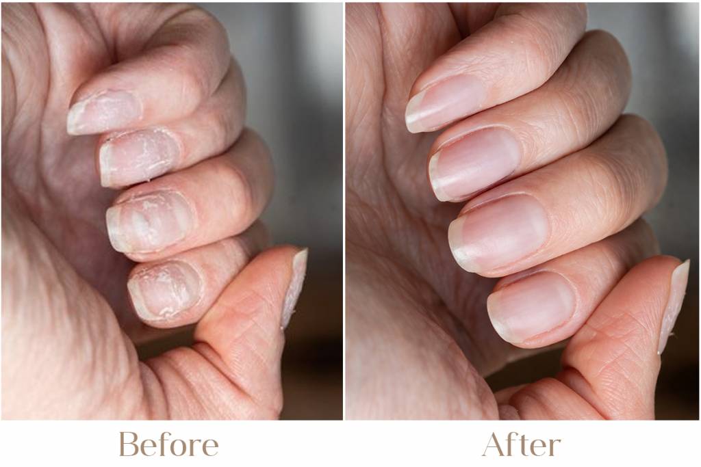 Nail Disorder Treatment in Delhi