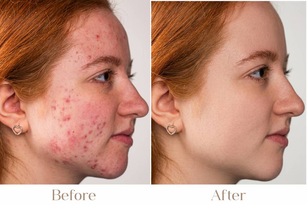 Hormonal Acne Treatment in Delhi