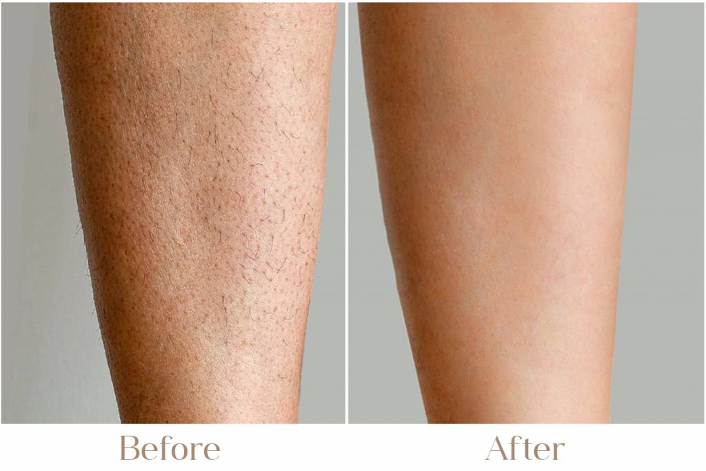PCOS Treatment in Delhi | Iksana Wellness
