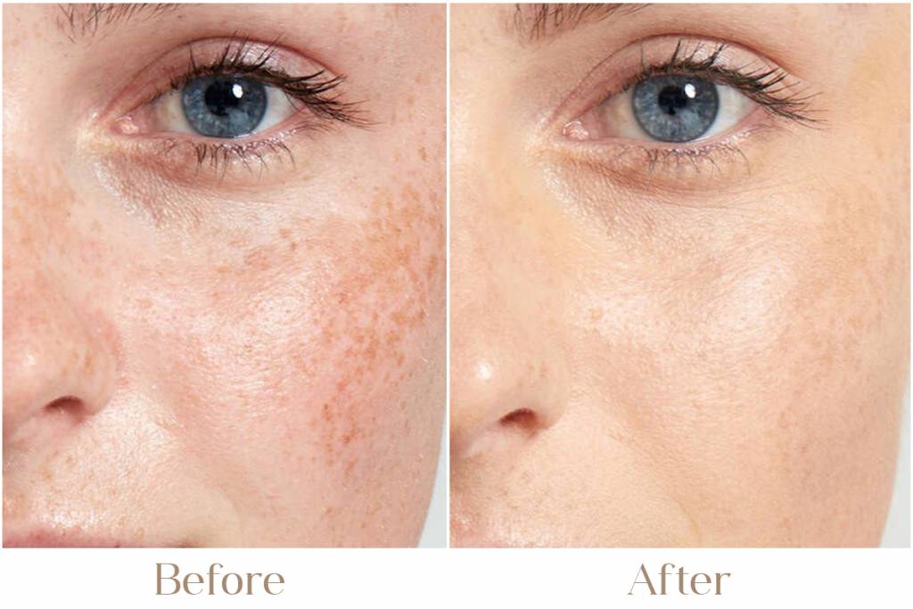 Melasma Treatment in Delhi | Iksana Wellness