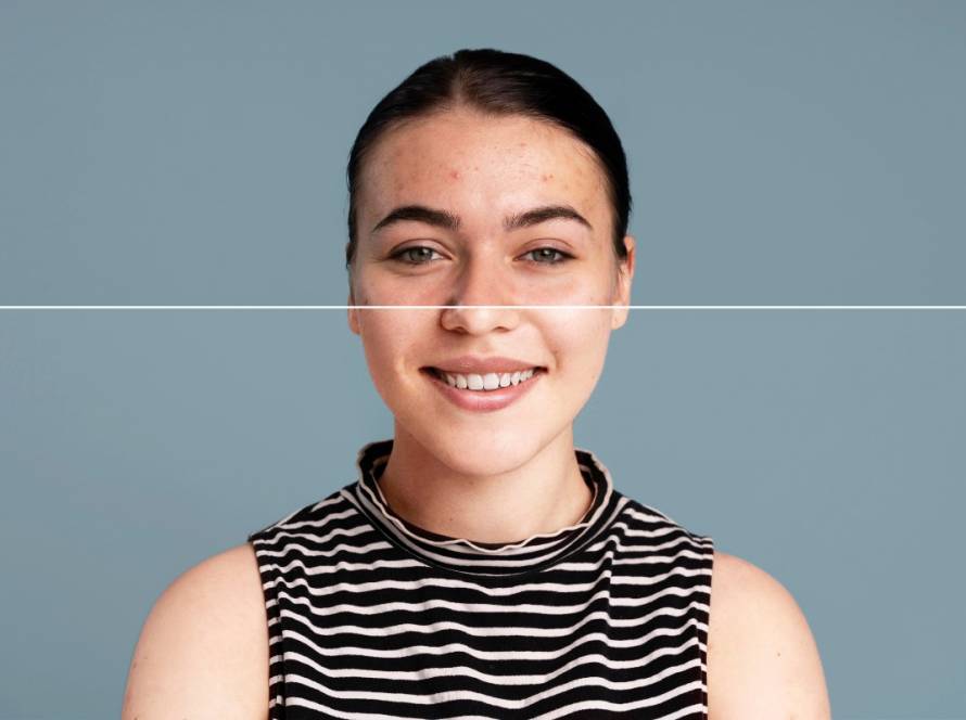 Melasma and Pigmentation