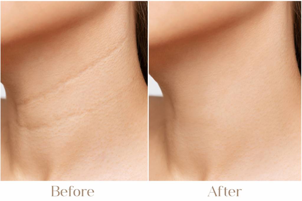 Neck Lift Treatment in Delhi