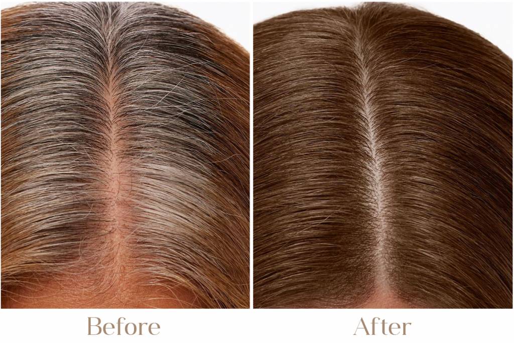 Premature Greying Treatment in Delhi