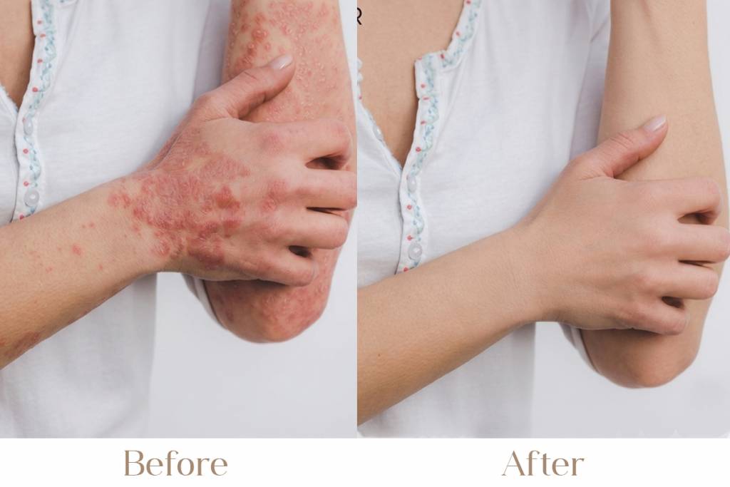 Psoriasis Treatment in Delhi
