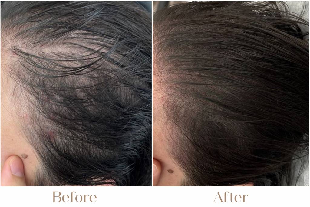 Scalp Micropigmentation in Delhi