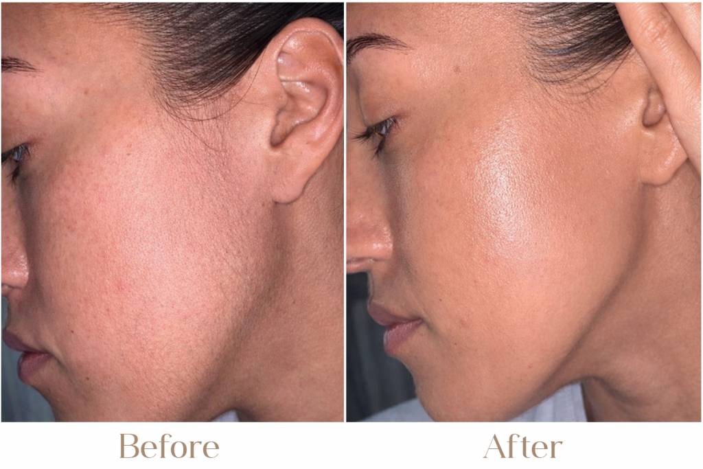 Soft Touch Laser Hair Reduction with MOTUS AX