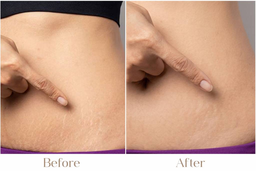Stretch Mark Reduction Treatment in Delhi | Iksana Wellness
