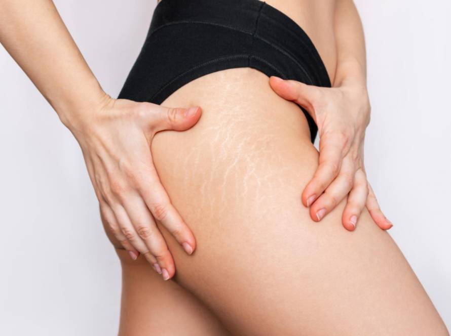 Stretch Mark Treatment in Delhi