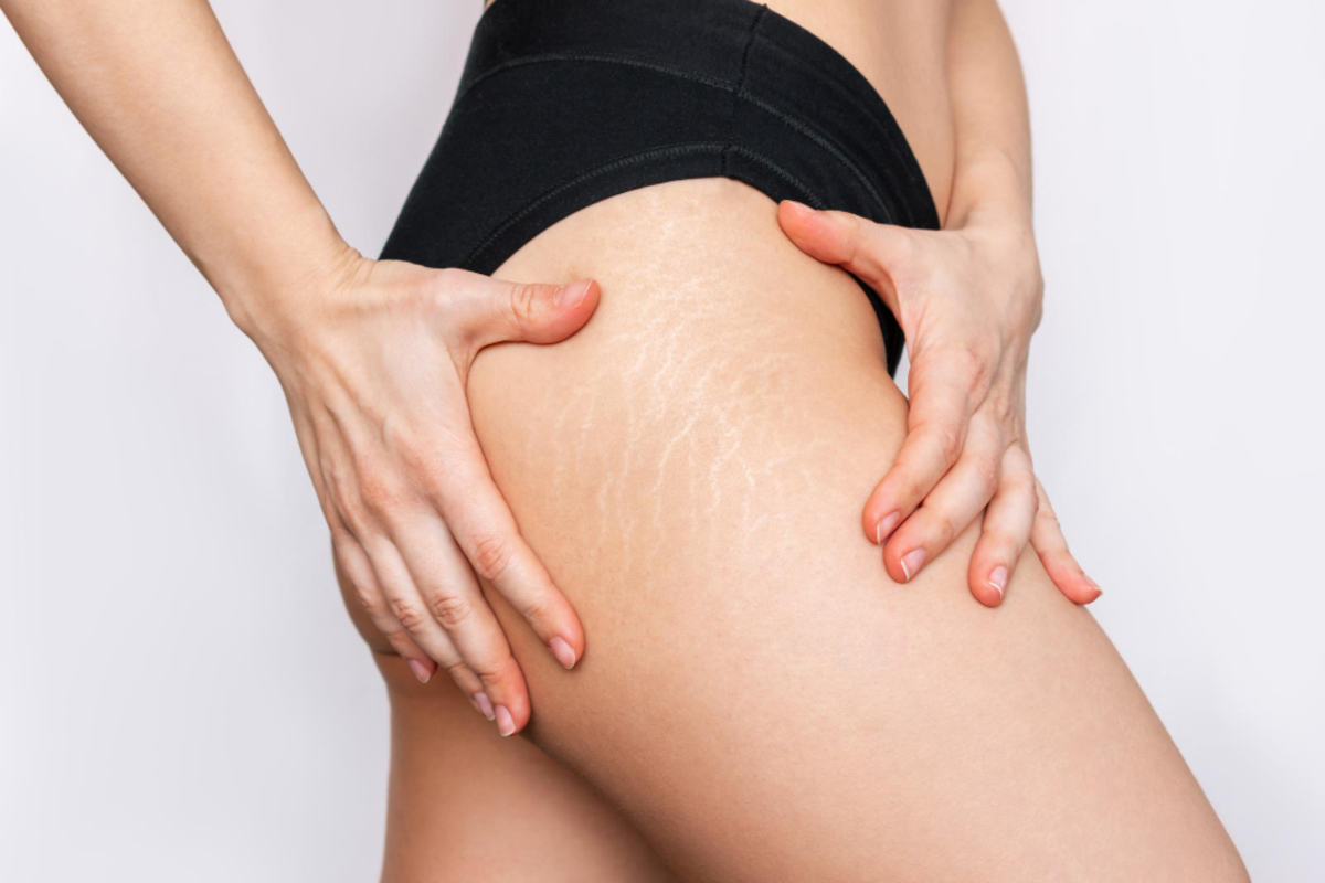 Stretch Mark Treatment in Delhi