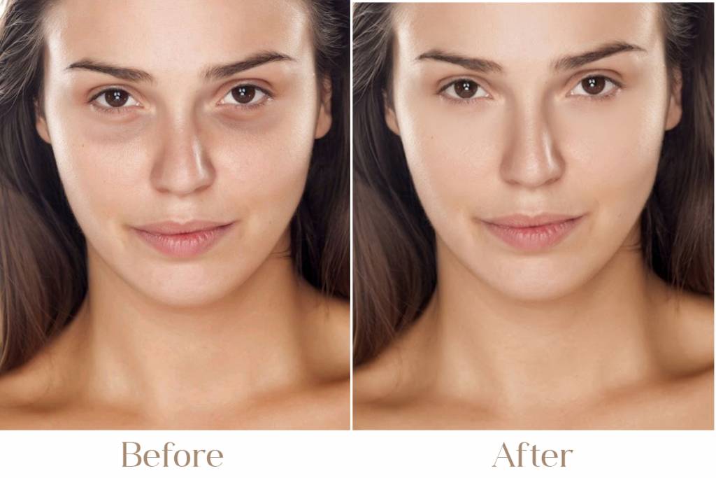 Advanced, Non-Invasive Solutions for Dark Circles & Under-Eye Bags