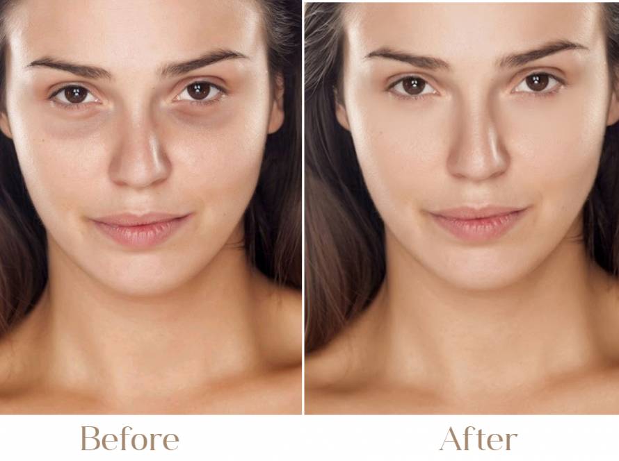 Under Eye Dark Circles, Hollowness & Bags