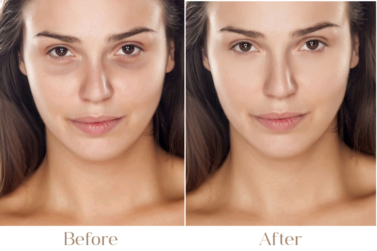 Under Eye Dark Circles, Hollowness & Bags