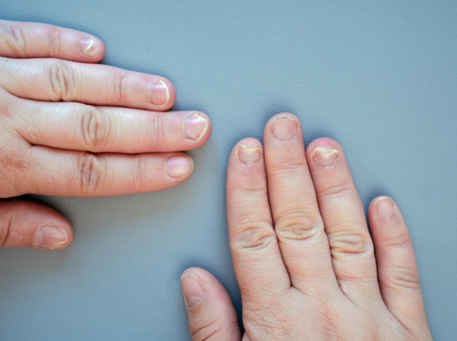 Nail Disorder Treatment in Delhi | Iksana Wellness