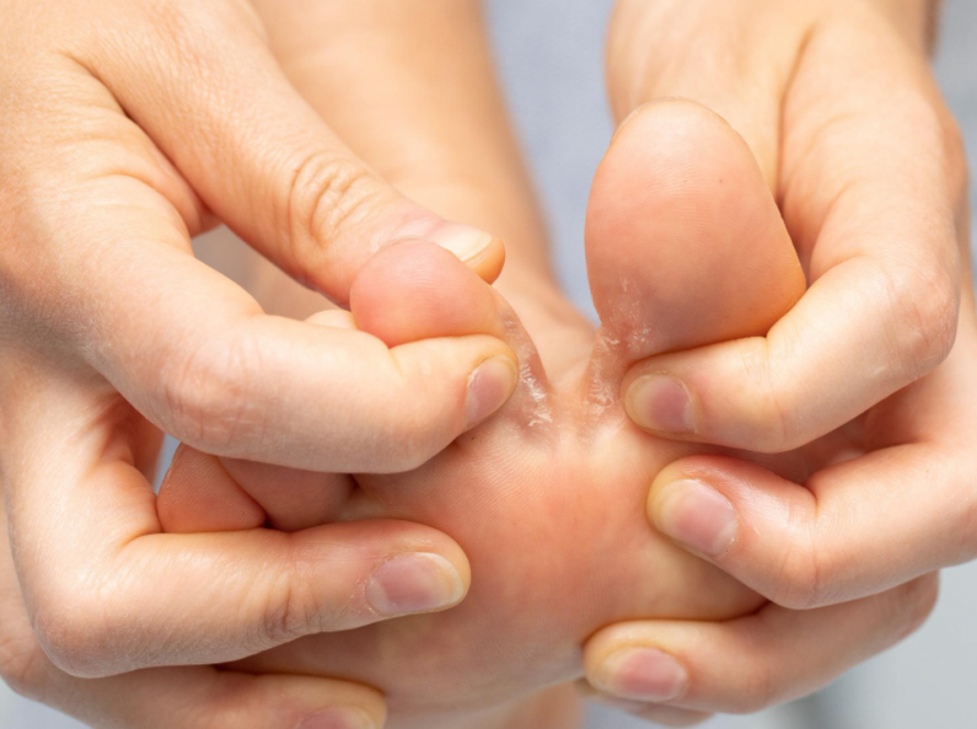 Fungal Infection Treatment in Delhi | Iksana Wellness