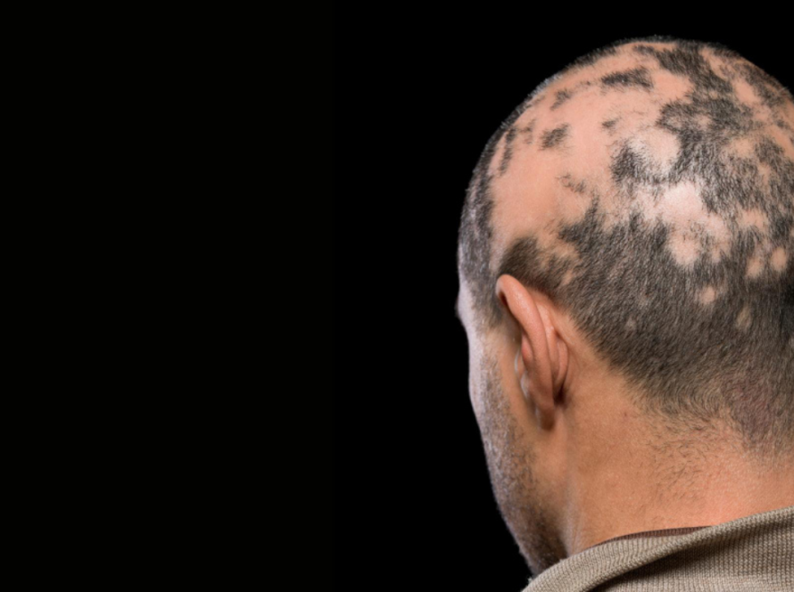 Alopecia Areata Treatment in Delhi | Iksana Wellness