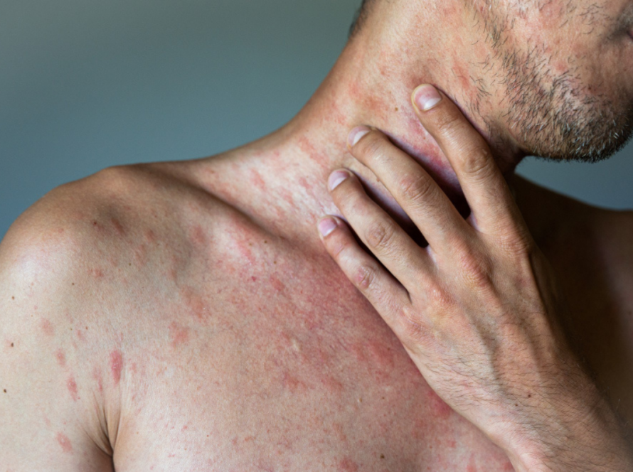 Urticaria Treatment in Delhi | Iksana Wellness