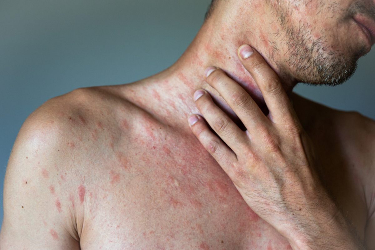 Urticaria Treatment in Delhi