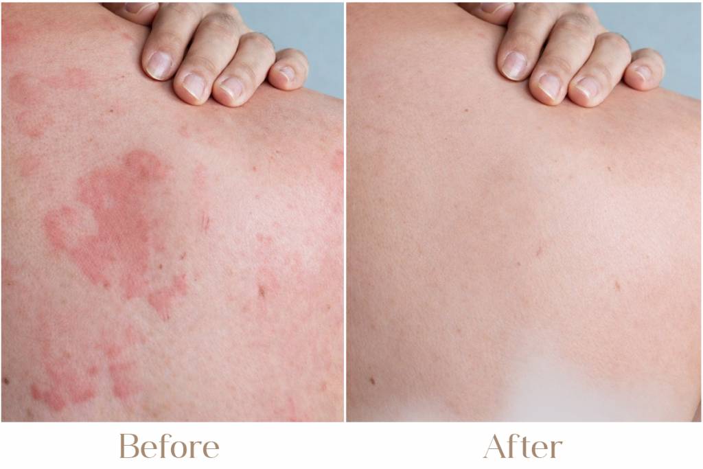 Urticaria Treatment in Delhi