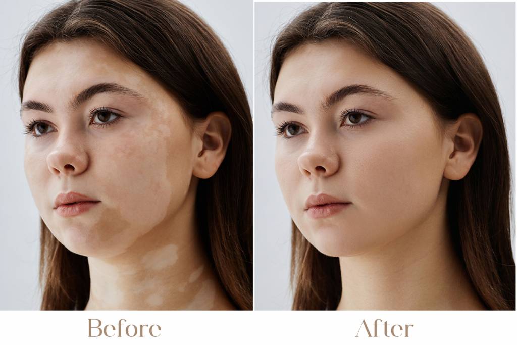 Vitiligo Treatment in Delhi