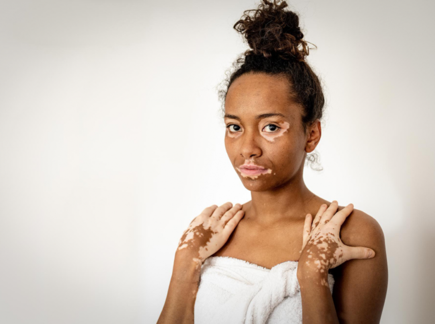 Vitiligo Treatment in Delhi