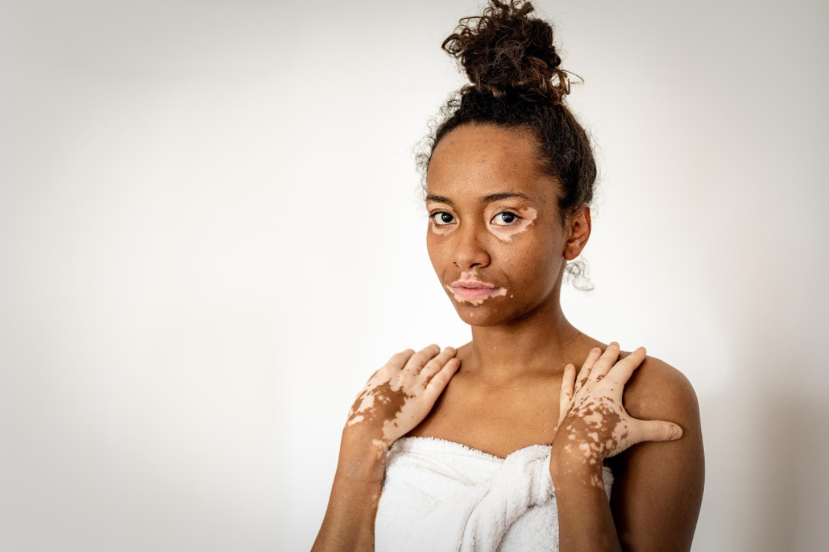 Vitiligo Treatment in Delhi