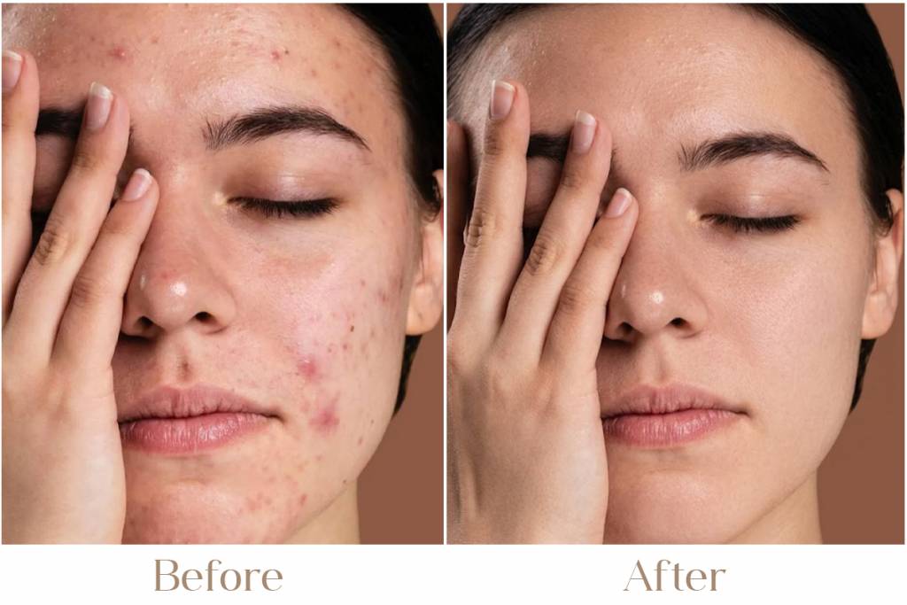 Whiteheads Treatment in Delhi
