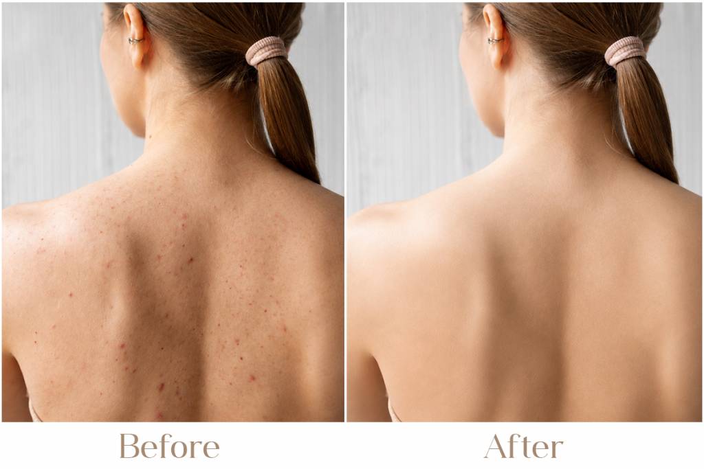 Body Acne Treatment in Delhi