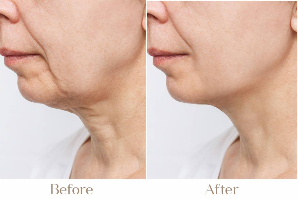 skin tightening treatment in delhi