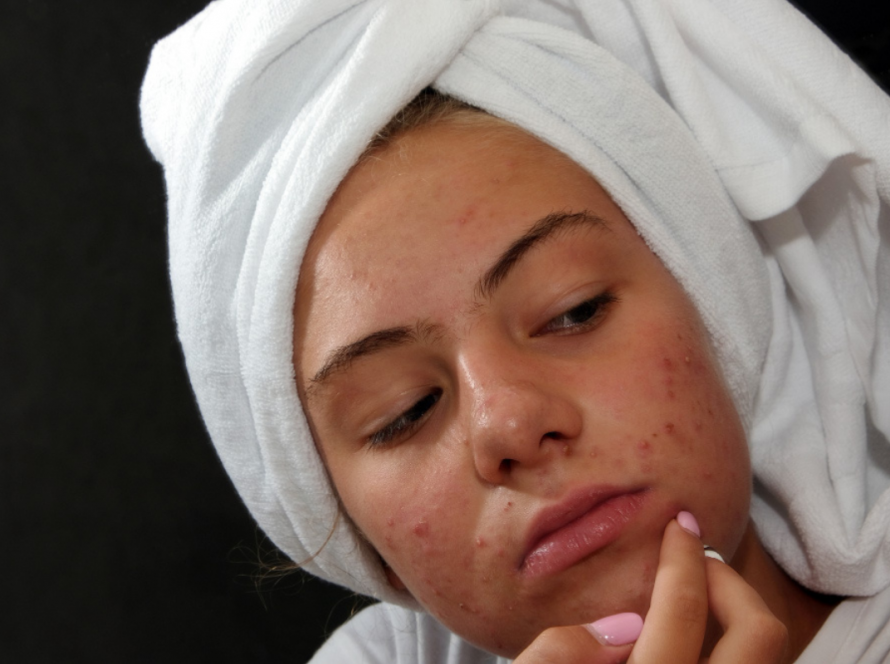 Active Acne Treatment in Delhi
