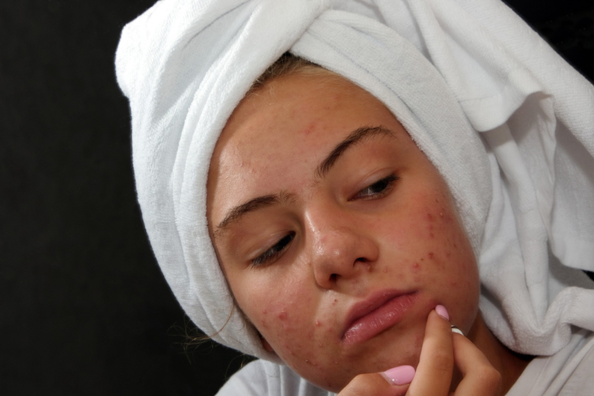 Active Acne Treatment in Delhi