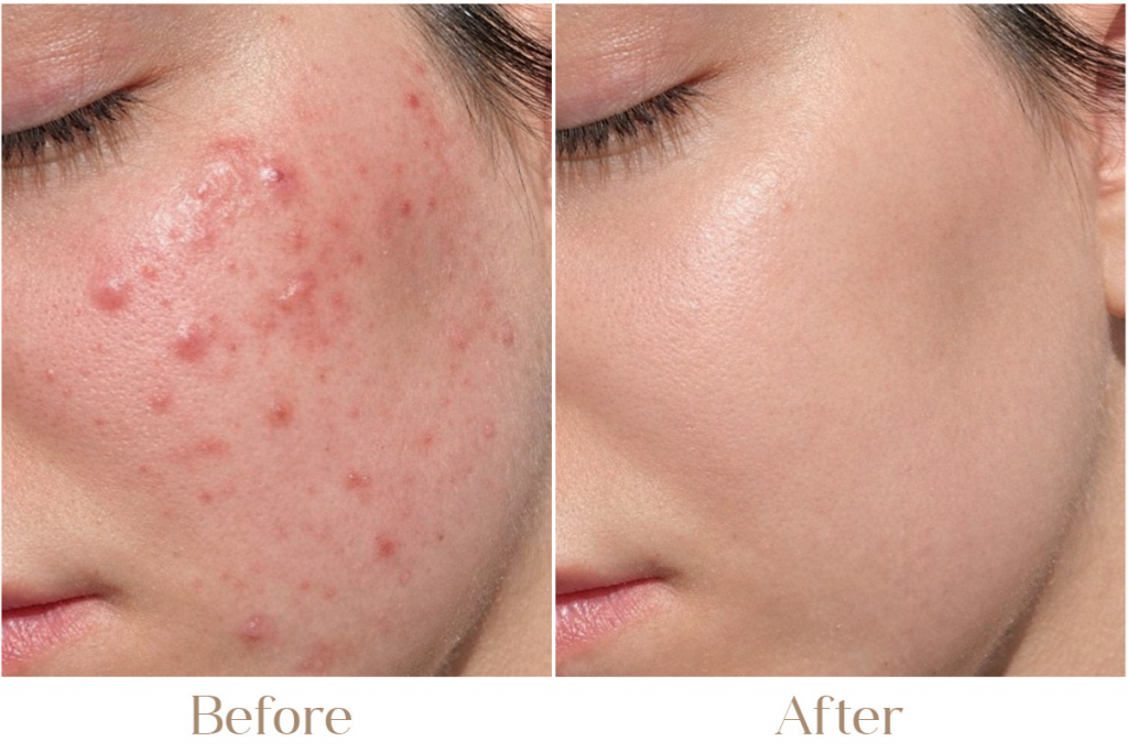 Active Acne Treatment in Delhi