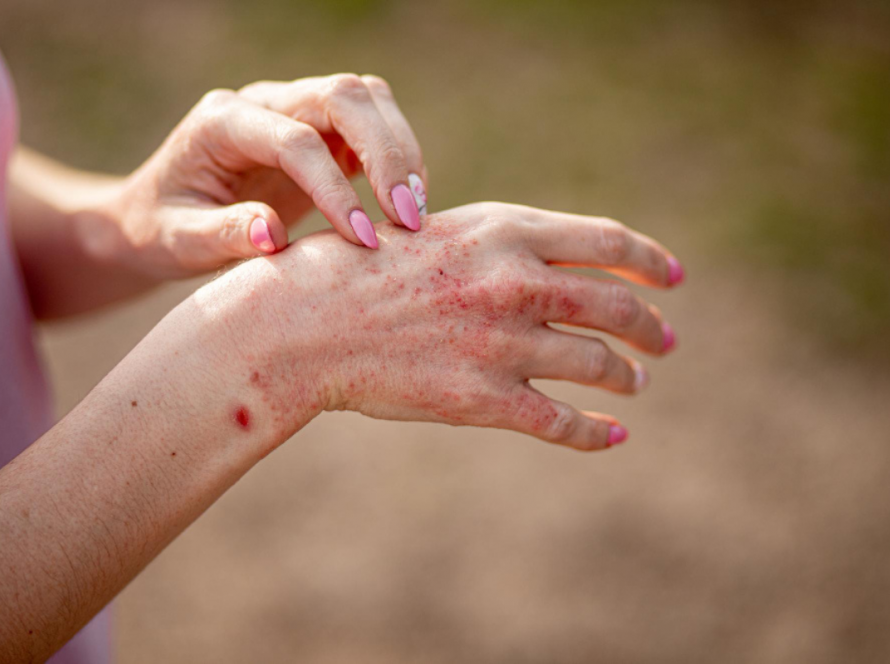 Advanced Eczema Treatment in Delhi