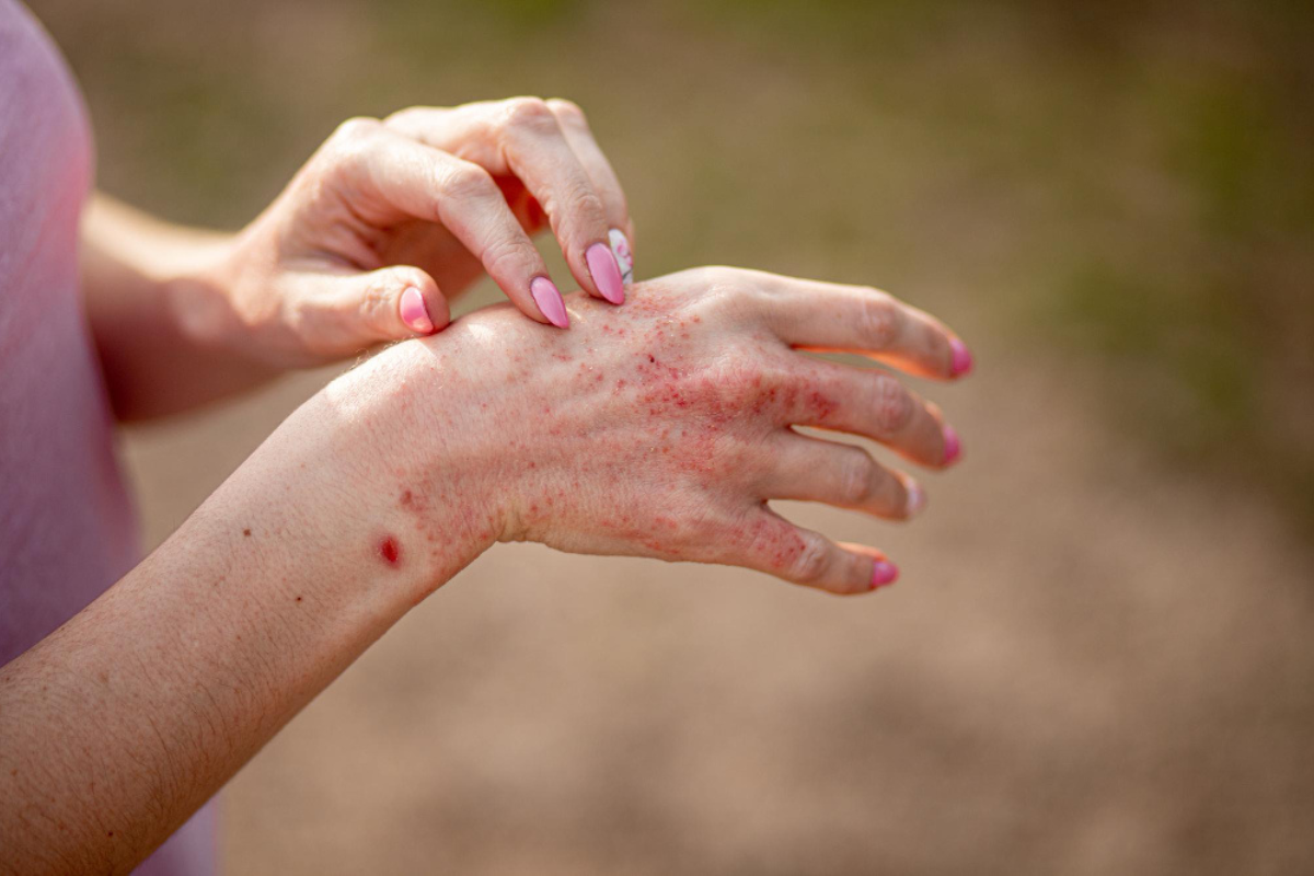 Advanced Eczema Treatment in Delhi