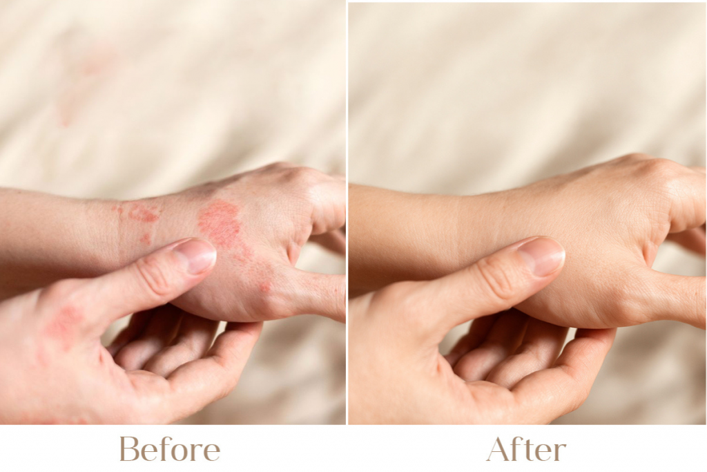 Advanced Eczema Treatment in Delhi