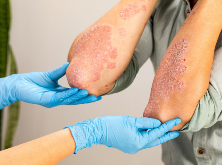 Advanced Psoriasis Treatment in Delhi
