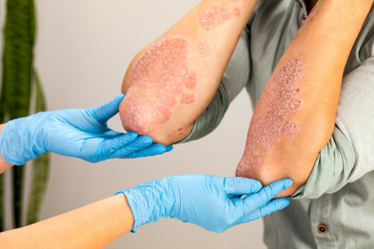Advanced Psoriasis Treatment in Delhi