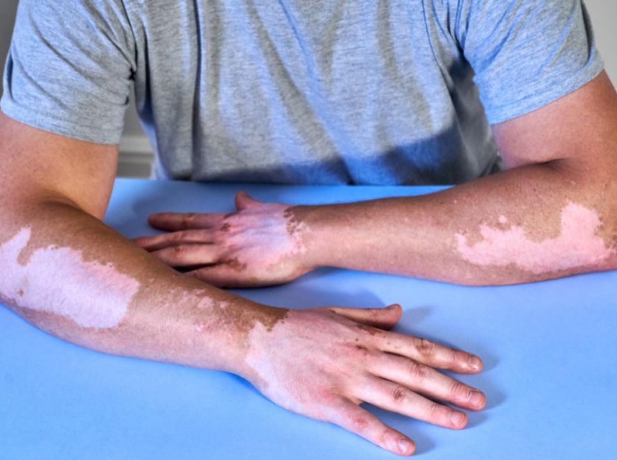 Advanced Vitiligo Treatment in Delhi
