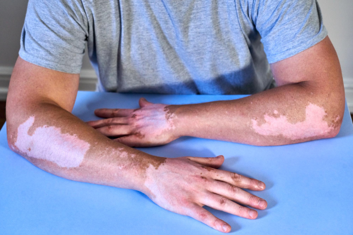 Advanced Vitiligo Treatment in Delhi