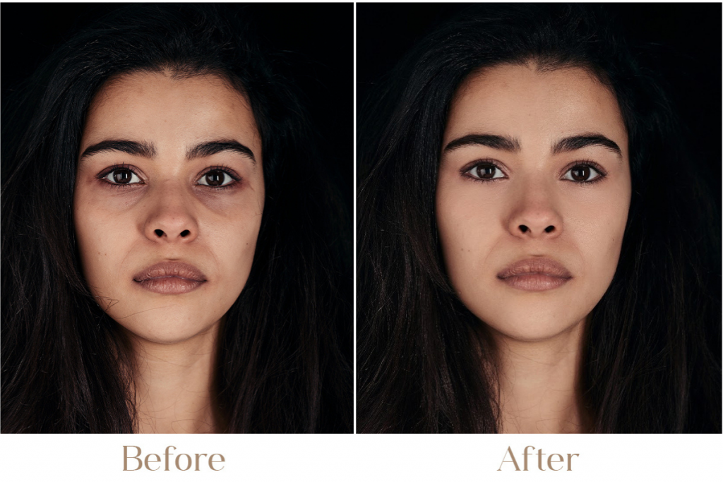 Dark Circles Treatment in Delhi