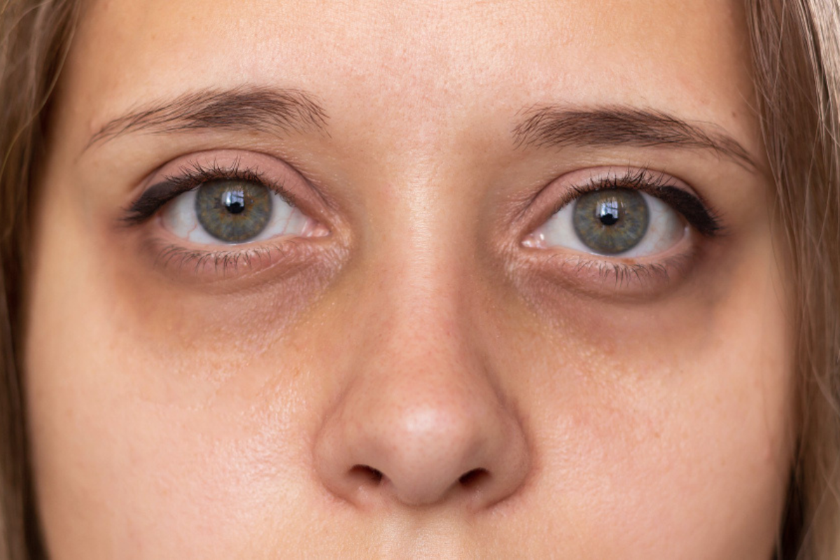 Dark Circles Treatment in Delhi