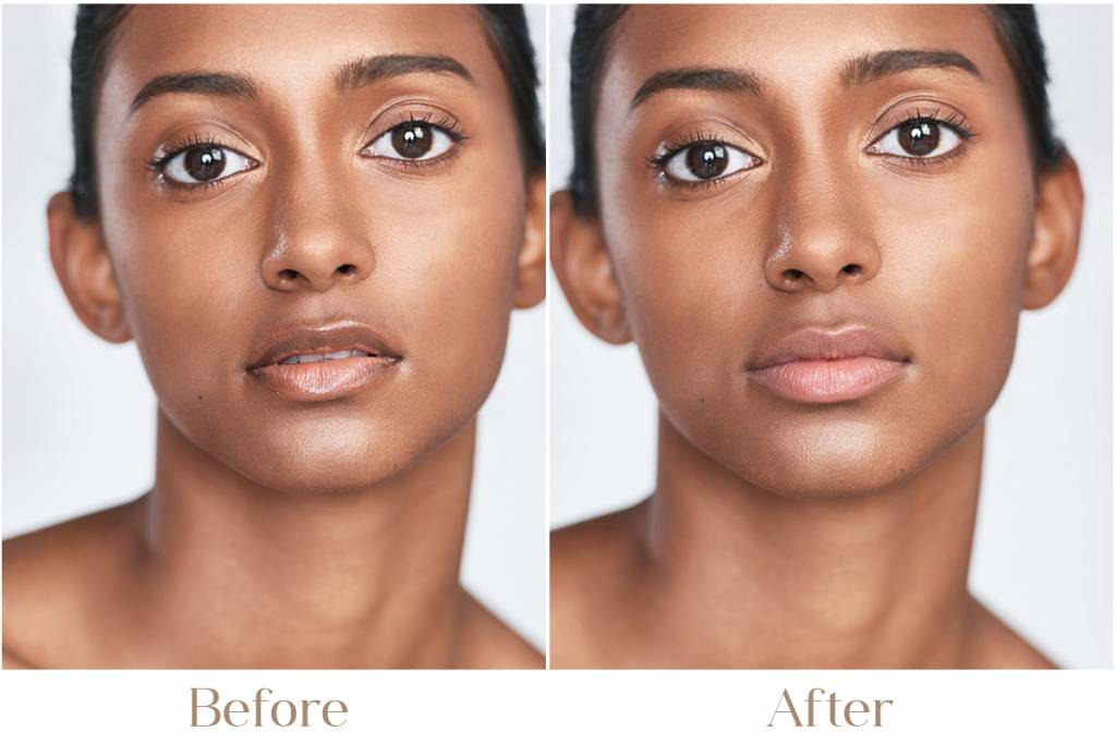 Dark Lips Lightening Treatment in Delhi